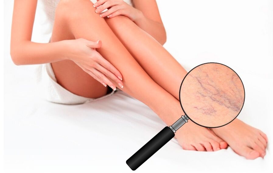 Neoveris will protect your legs from varicose veins