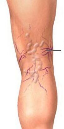 Different veins