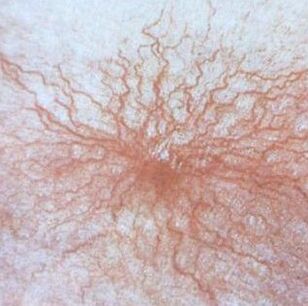 Telangiectasia