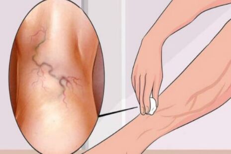 Different veins
