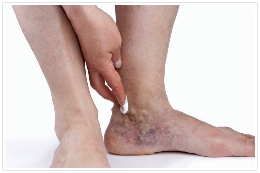 The benefits of the vein procedure