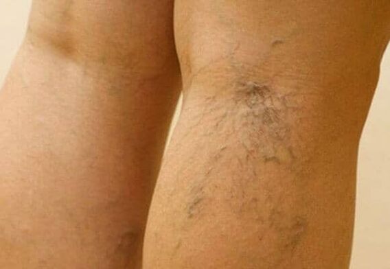 Different veins