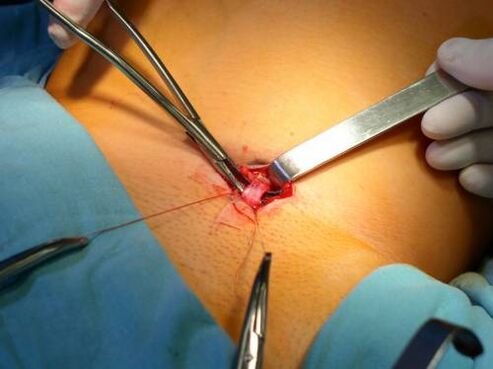 Flbectomy