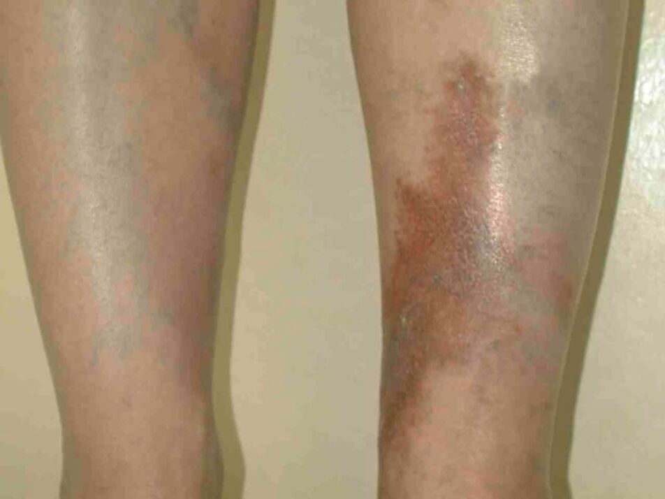 Stages of varicose veins