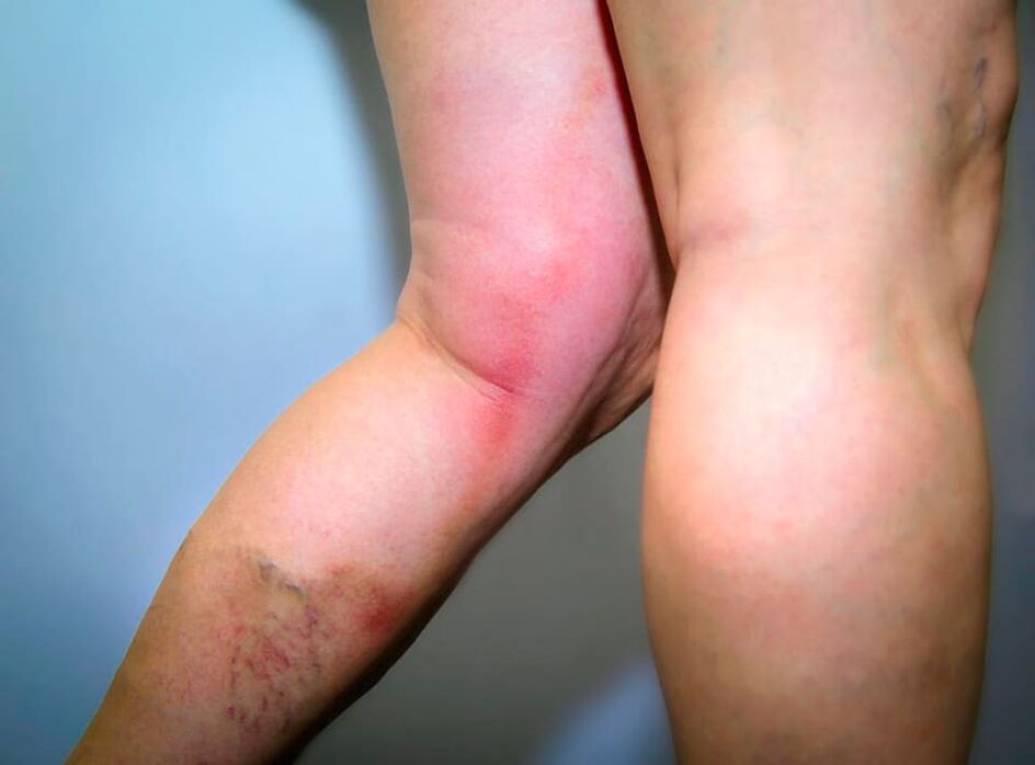 The effects of varicose veins