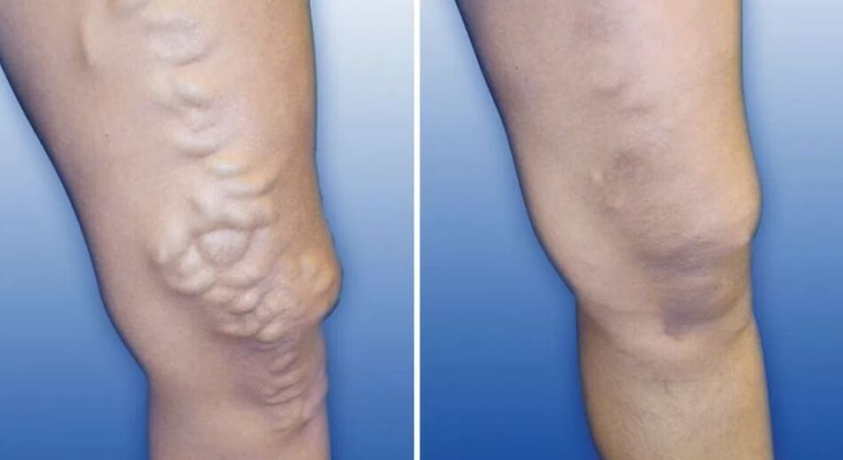 Varicose veins