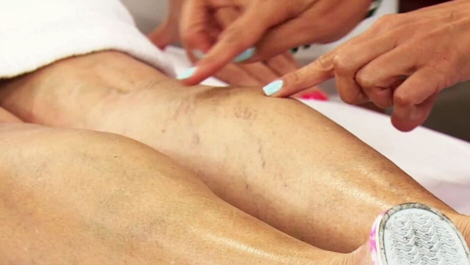 varicose veins on the lower legs