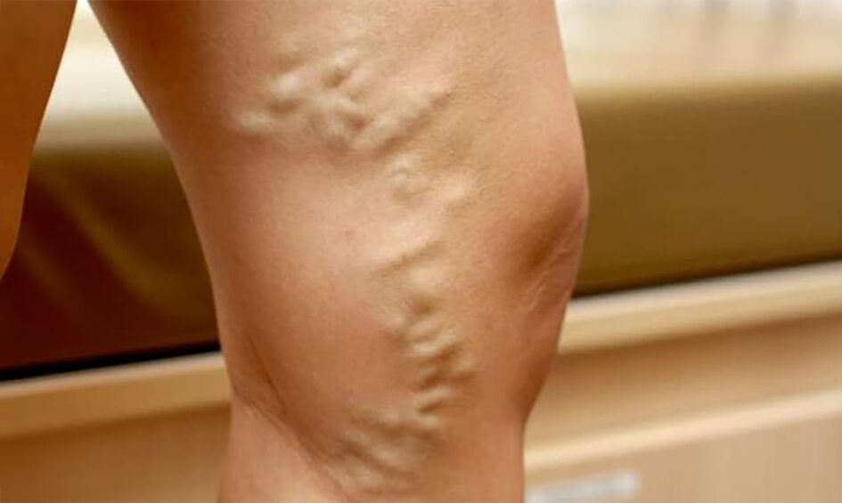 varicose veins