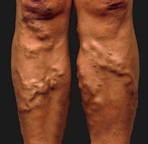 Different veins