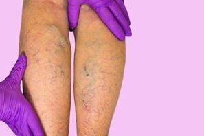 Varicose veins on the legs