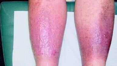 third stage of varicose veins of the legs