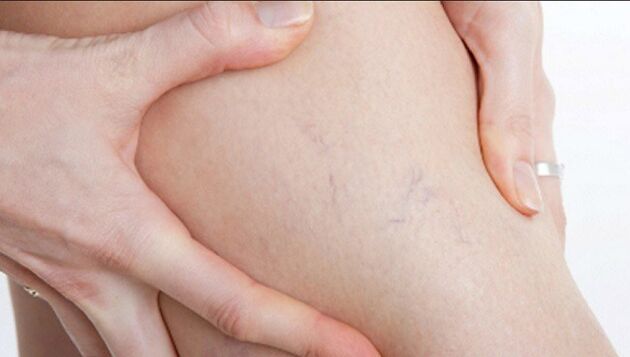 Spider veins on the legs are a sign of varicose veins