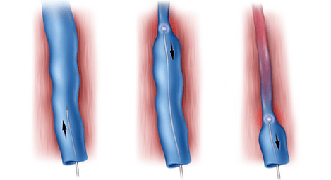 radiofrequency ablation is a method of treating varicose veins