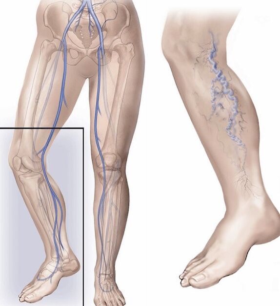 healthy veins and veins affected by varicose veins