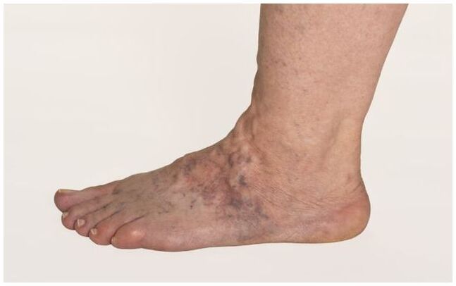 Varicose veins of the legs of a man complicated by trophic ulcers