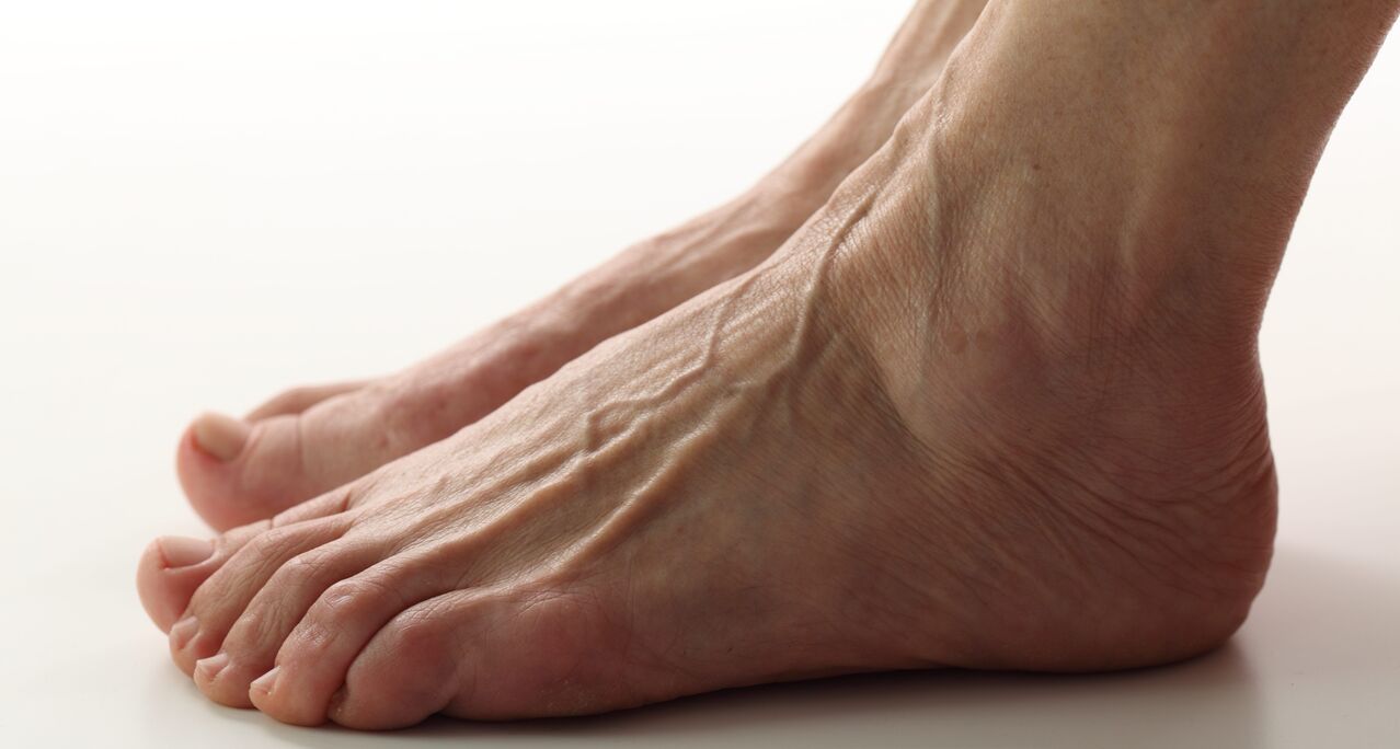 varicose veins of the legs