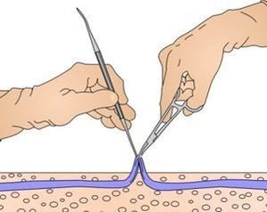 Miniphlebectomy - removal of part of the vein affected by varicose veins