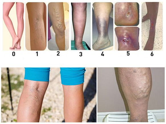 Stages of development of varicose veins of the lower extremities