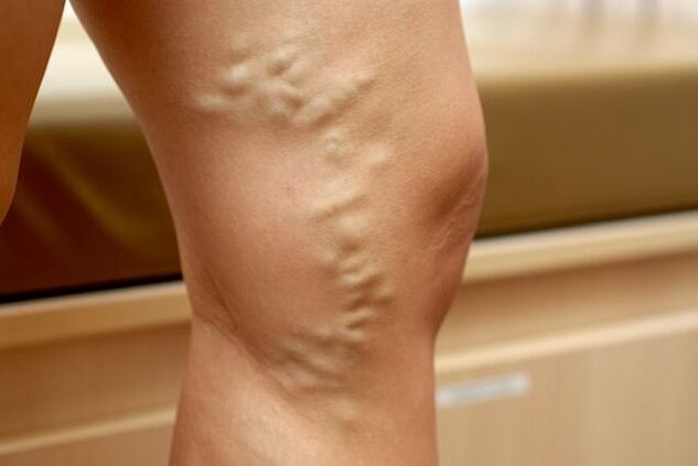 Protruding deformed leg vein with varicose veins stage 3