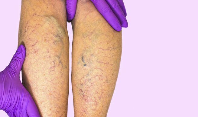 Varicose veins of the legs