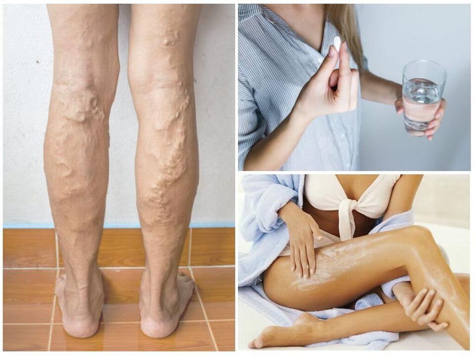 Varicose veins of the lower extremities and methods of its treatment