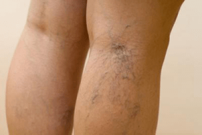 photo of varicose veins of the legs