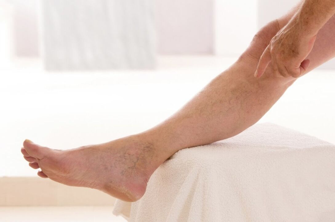 symptoms of varicose veins of the legs